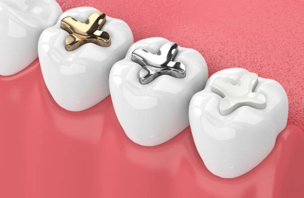 3d render of jaw with teeth and three types of inlay over white