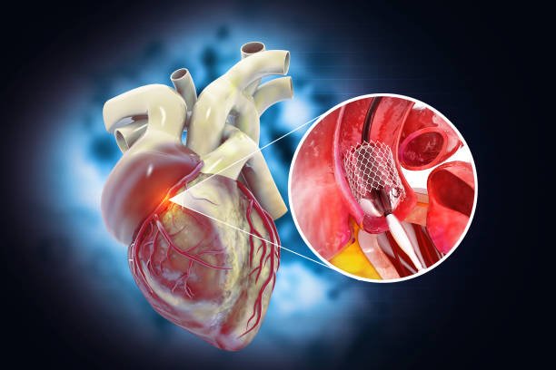 Balloon angioplasty procedure with stent in vein.3d illustration