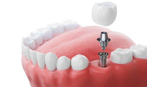Dental implantation, teeth with implant screw, 3d illustration.